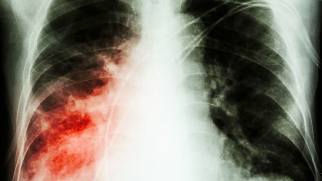 An X-Ray of a lung infected with legionnaires' disease
